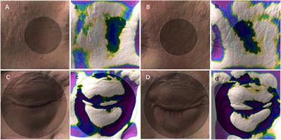 Temporal and periorbital depressions identified by 3D images are correlated with malnutrition phenotypes in cancer patients: A pilot study